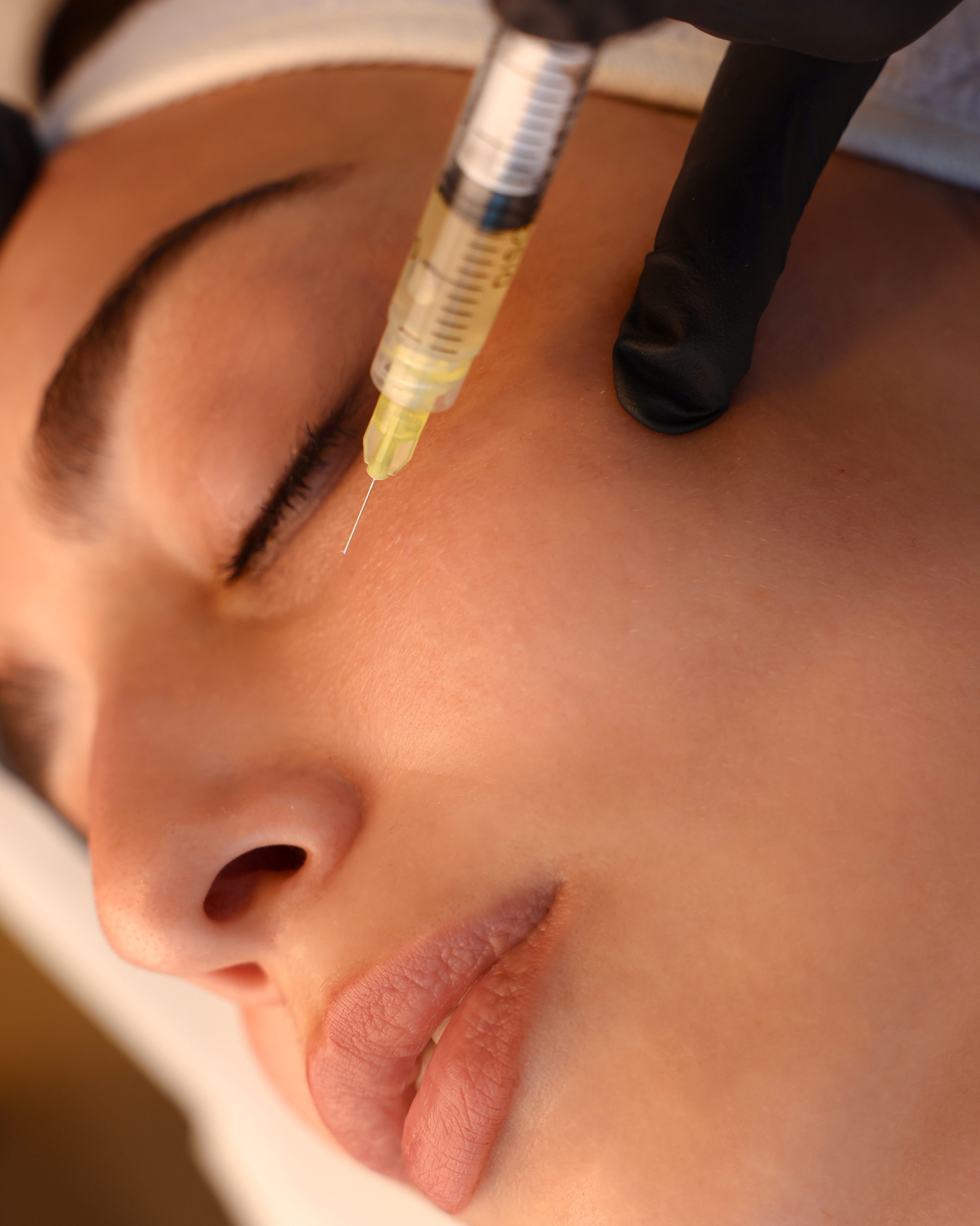 Skin boosters/Biostimulators