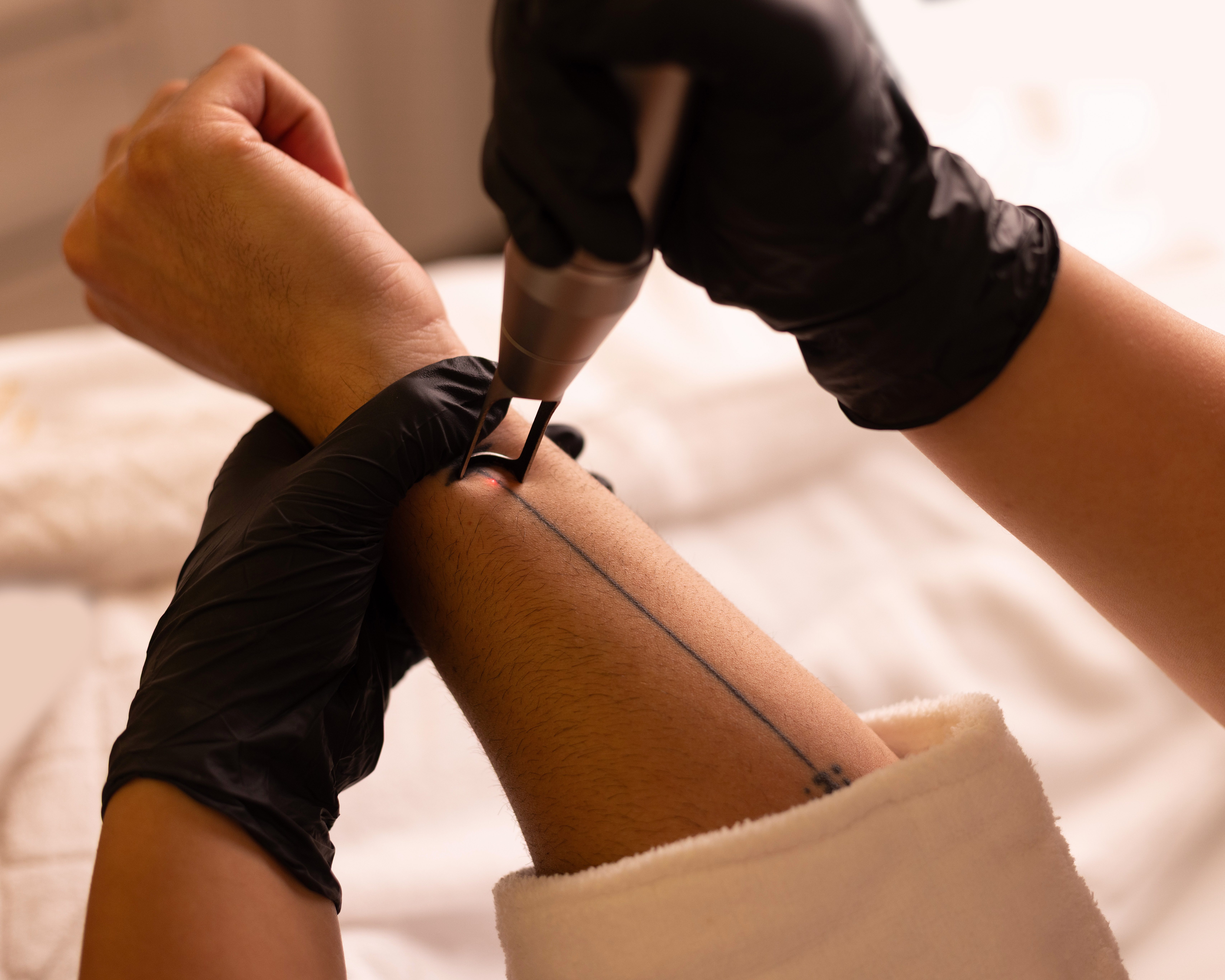 Tattoo Removal
