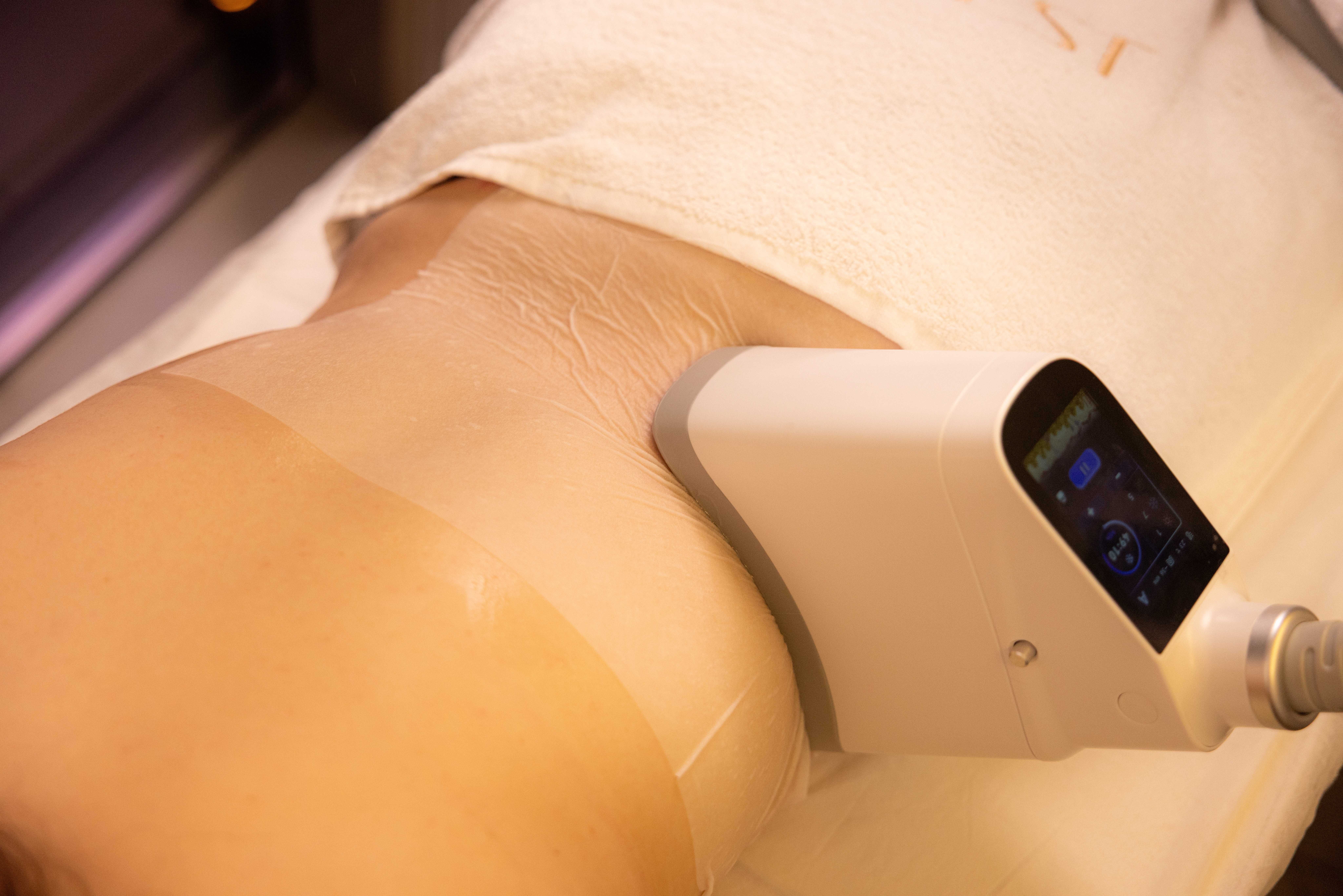 Fat Freezing